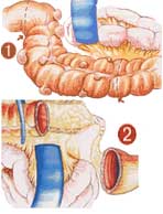 Diverticoli: quando toglierli