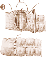 Diverticoli: quando toglierli