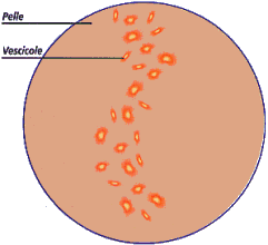 Herpes simplex