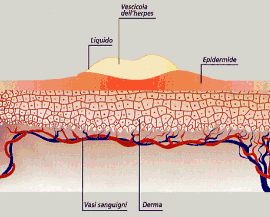 Herpes simplex