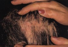 Alopecie cicatriziali acquisite