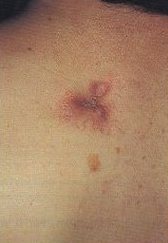 Dermatofibrosarcoma protuberantis