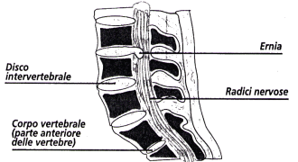 Ernia del disco