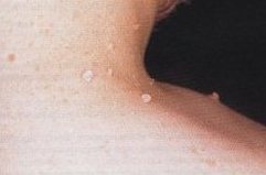 Fibroma molle