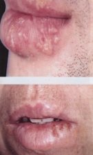 Herpes simplex