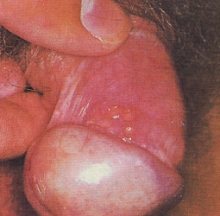 Herpes simplex