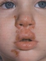 Impetigine volgare