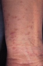 Lichen planus