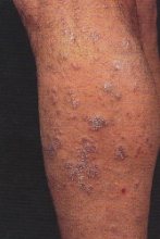 Lichen planus
