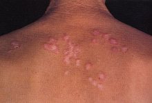 Lupus eritematoso