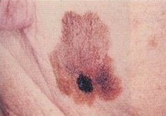 Melanoma cutaneo