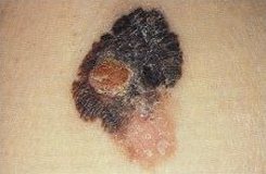 Melanoma cutaneo