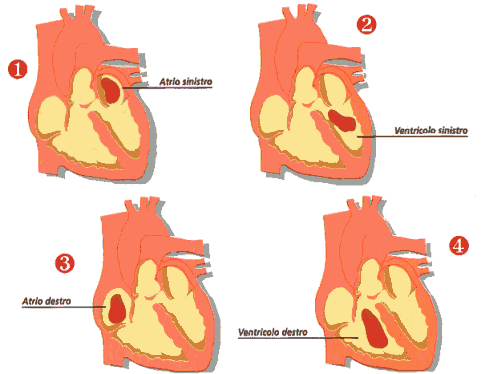 Mixoma: tumore del cuore