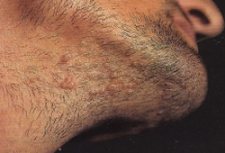 Mollusco contagioso