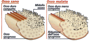 Osteoporosi