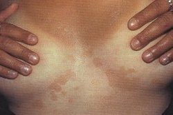 Pityriasis versicolor