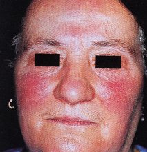 Rosacea