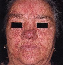 Rosacea