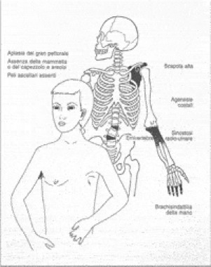 Sindrome di Poland