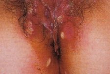 Sindrome di Behçet