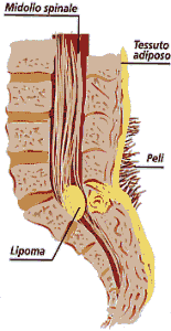 Spina bifida: si pu prevenire