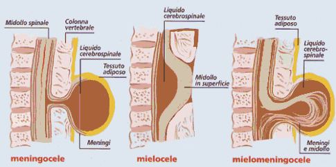 Spina bifida: si pu prevenire