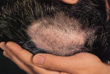 Alopecia areata