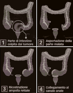 Tumore dell